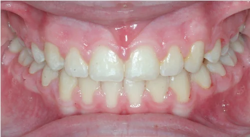 after Image