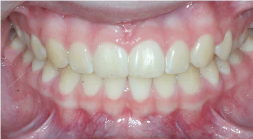 after Image