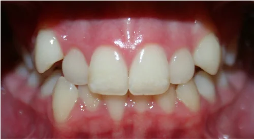 before Image